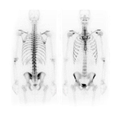 Nuclear Medicine - Bone Scan